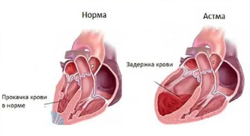 сердечная астма